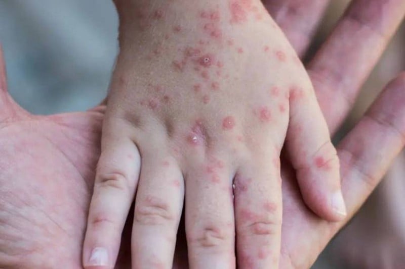 epidemie de variole du singe
